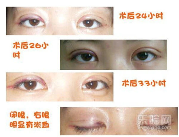 埋线双眼皮好吗 护肤 第3张