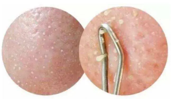 鼻子上挤出的白色东西是什么，三种方法清除他 鼻子 鼻子上挤出的白色东西是什么 美容 第4张