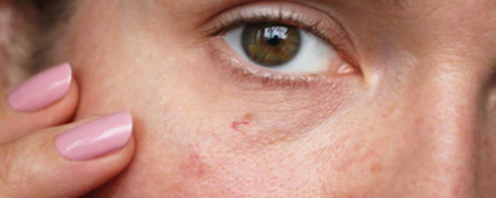 红血丝怎么治 红血丝 美妆 第1张