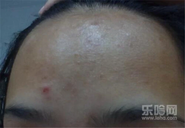 压力大额头长痘怎么办 护肤 第4张