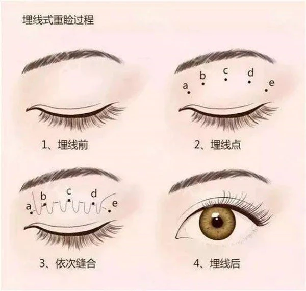 如何选择合适的双眼皮类型，双眼皮的种类 双眼皮 第5张