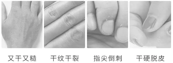 手老是脱皮怎么办，第二张脸也需要护肤 脱皮 手脱皮 手老是脱皮怎么办 美容 第2张