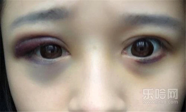 埋线双眼皮淤青怎么办 护肤 第5张