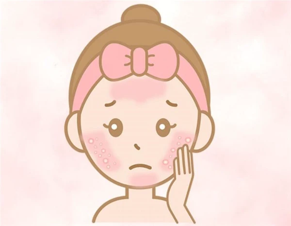 如何分辨「玫瑰痤疮」与「暗疮」，玫瑰痤疮常见4大病发阶段 玫瑰痤疮 暗疮 第2张