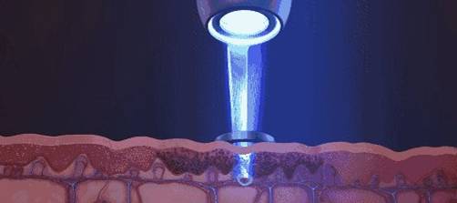 做完皮秒祛斑几天可以洗脸 祛斑 皮秒祛斑 美妆 第1张