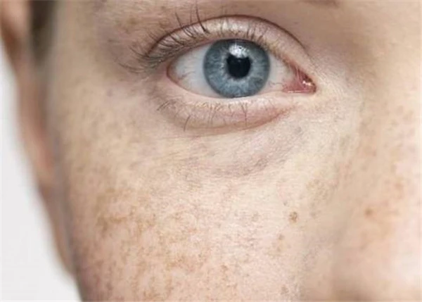 祛黄褐斑的最佳方法是什么 黄褐斑 祛黄褐斑 美妆 第2张