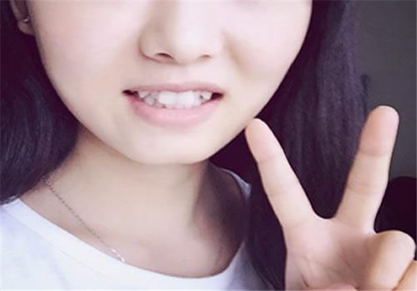 矫正虎牙会改变脸型吗 护肤 第1张 矫正虎牙会改变脸型吗 护肤 第1张