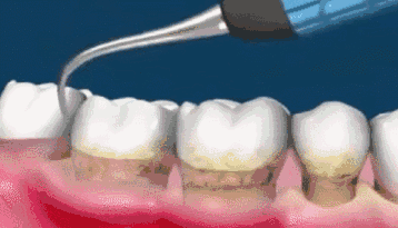 牙齿为什么越来越黄？常见的三种美白方式了解一下
