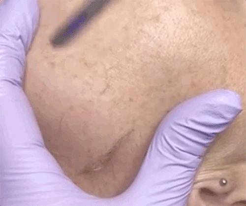 除了拍照磨皮还不够,欧美女生迷上了人工磨皮