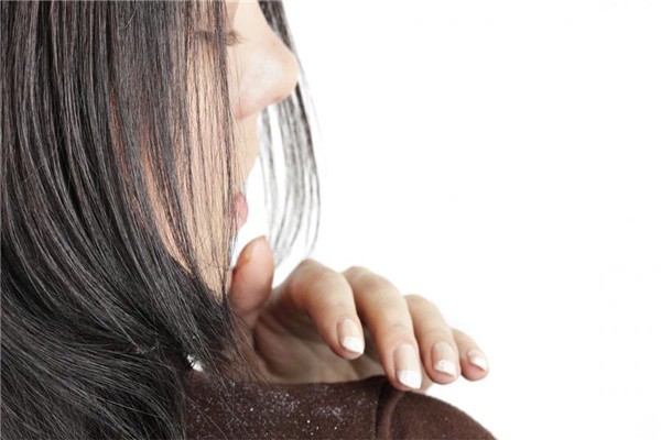 秋季头皮屑多，3种食物尽量少吃，2个小妙招或能减少头皮屑