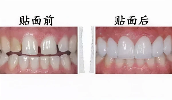 牙齿为什么越来越黄？常见的三种美白方式了解一下