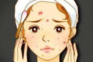 青春痘是皮肤病吗，青春痘要挤掉吗