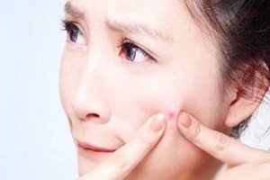 痘痘长到多少岁，长痘需要注意些什么