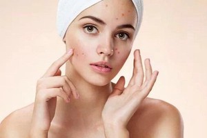 痘痘挤了一直流血怎么办，痘痘挤了一半没挤干净怎么办