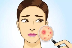 长痘痘能涂防晒霜吗，长痘痘用什么防晒霜好