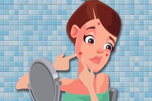 痘痘挤了之后怎么处理，痘痘挤了之后会留痘印吗